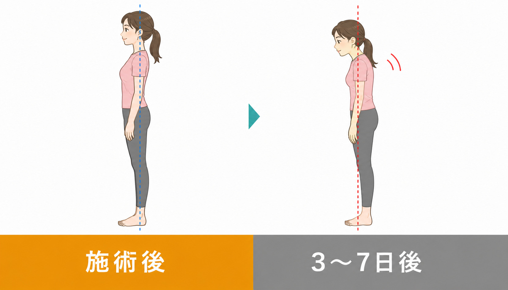 施術後から3〜7日後の姿勢変化